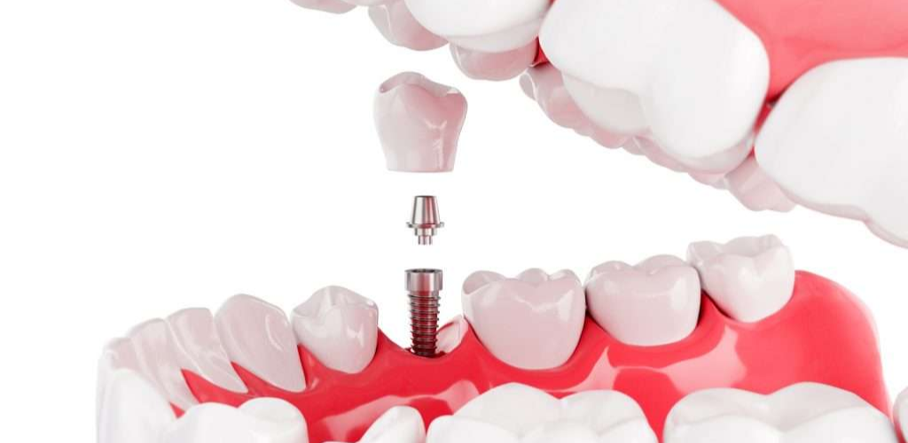 How to Overcome Your Fear of the Dentist