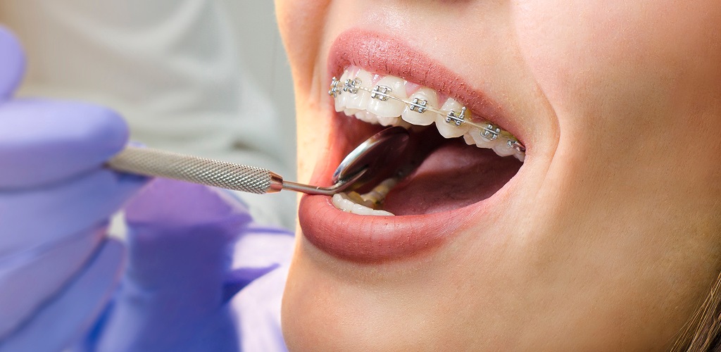 Braces & Orthodontics in Durban: Not Just for Teens Anymore