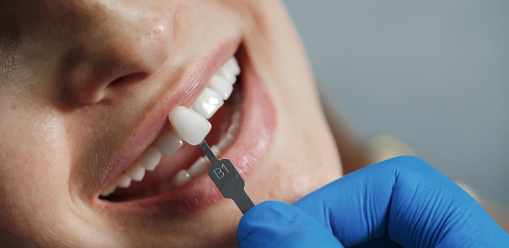 Considering Dental Implants in Durban? Start Here